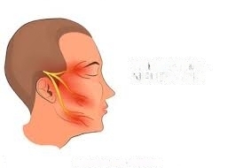 Seven Things You Should Know About Trigeminal Neuralgia